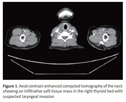 Radiation-associated sarcomatoid carcinoma of the larynx as a late complication of papillary thyroid cancer treatment