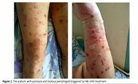UVB-induced bullous pemphigoid in a patient with psoriasis