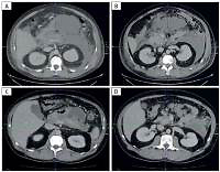 Effective treatment of severe acute pancreatitis and COVID-19 pneumonia with tocilizumab
