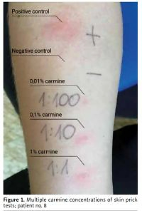 Carmine allergy in urticaria patients