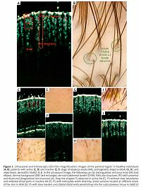Usefulness of high-frequency ultrasonography
in the assessment of alopecia areata – comparison
of ultrasound images with trichoscopic images