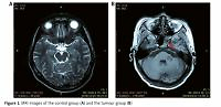 The role and significance of magnetic resonance imaging
and miRNA-125b expression level in diagnosis of head
and neck squamous cell carcinoma