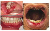 Clinical profile of oral pemphigus vulgaris in Thai patients