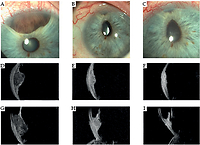 Pictorial essay: Radiological and clinical findings in uveal melanoma treated by plaque interventional radiotherapy (brachytherapy): Visual atlas and literature review on response assessment