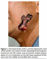 Myoepithelial differentiation subsequent to giant basal
cell carcinoma in the left face