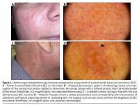 Clinical and histopathological characteristics of primary
and recurrent basal cell carcinoma: a retrospective study
of the patients from a tertiary clinical centre
in the northern Poland