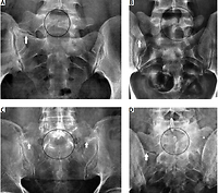 Co-existence of spina bifida occulta and lumbosacral transitional
vertebra in patients presenting with lower back pain