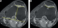 The association between patellofemoral alignment and osteoarthritis in magnetic resonance imaging