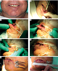 Pictorial essay: High-dose-rate brachytherapy (interventional radiotherapy) in lip carcinoma with rigid needles: 
a simple technique with excellent results