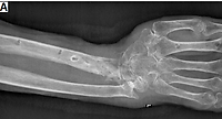 An aggressive course of pyoderma gangrenosum mimicking bacterial osteomyelitis after open reduction and internal fixation of a distal radius fracture with a titanium plate