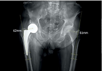 Hip hemiprosthesis due to femoral neck fracture in elderly population – are we doing it right?