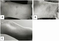 Cutaneous larva migrans – case report and literature review