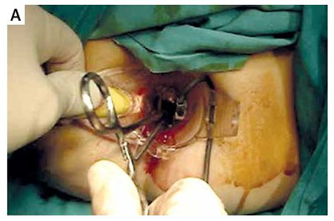 Evaluation of transanal hemorrhoidal dearterialisation (THD)-mucopexy as a successful treatment for stage IV haemorrhoids: a prospective, observational study and a literature review