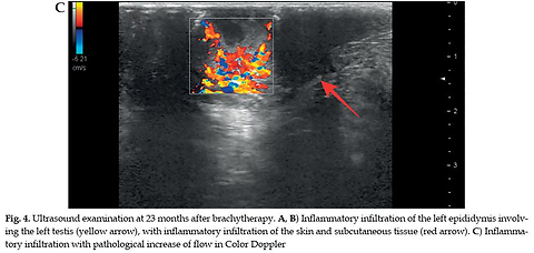 Orchiepididymitis as a rare complication of TURP performed four weeks after high-dose-rate brachytherapy for prostate cancer