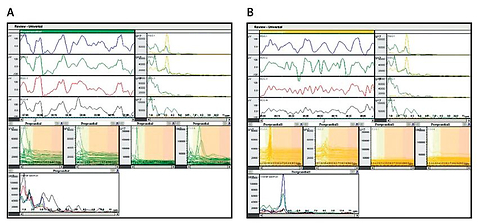 Disturbances of autonomic nervous system and gastric activity in response to visceral stimulation in functional dyspepsia patients
