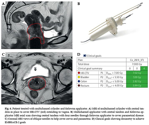 Selection of hybrid applicators for adaptive cervical cancer brachytherapy: A practical guide