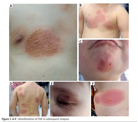 Ibuprofen-induced multiple fixed drug eruption in a 3-year-old child confirmed by patch testing