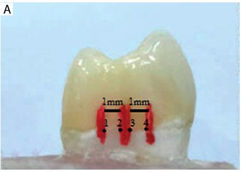 Effect of different luting agents on vertical marginal fit of full contour CAD/CAM zirconia crown restorations: a comparative in vitro study