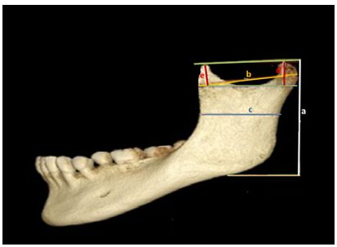 Sexual dimorphism in mandibular morphometry: a comparative cone beam computed tomography study of Egyptian and Saudi populations