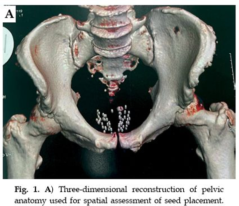 Permanent seed brachytherapy for prostate cancer: Monotherapy, combined, and salvage approaches remain effective and well-tolerated options