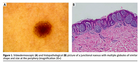 Globules in pigmented lesions: dermoscopic and pathomorphological correlation