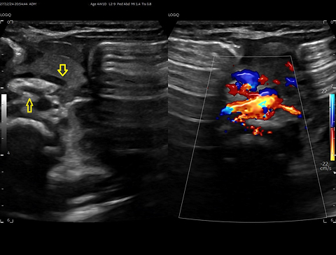 Unveiling midgut volvulus: the critical role of ultrasound