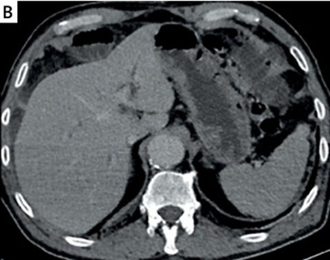 Gallstone ileus: a case report of small bowel obstruction