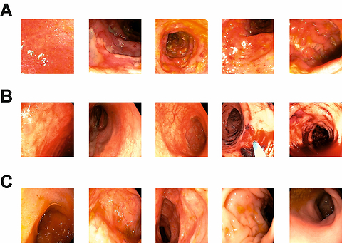 Rescue therapy with upadacitinib in severe Crohn’s disease
