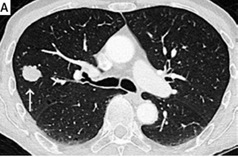 An unusual case of pancreatic metastasis from malignant melanoma. The diagnostic work-up to arrive at a final diagnosis