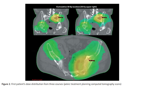 Reirradiation and teclistamab in relapsed multiple myeloma: initial experience in two heavily pretreated patients with extensive disease