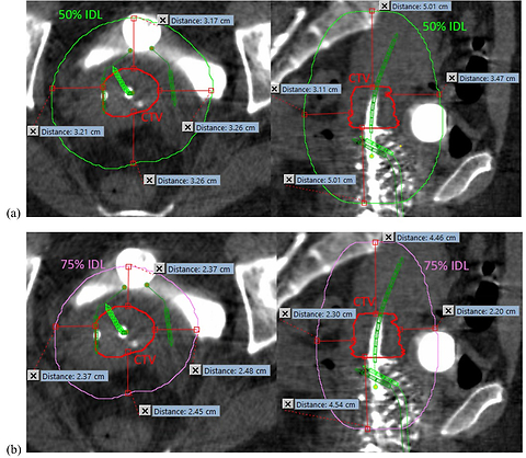 Development of a patient-specific adaptive ring for organ at risk contours in high-dose-rate brachytherapy gynecologic cancers