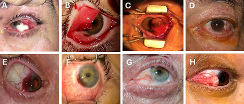 Ruthenium-106 ocular surface brachytherapy for incompletely excised conjunctival melanoma and squamous cell carcinoma