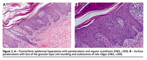 Early and significant improvement of rupioid psoriasis with bimekizumab