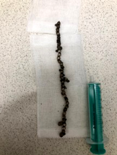 The foreign body in the urinary tract in paediatric population: a case series of self-insertion of metallic objects into the lower urinary tract