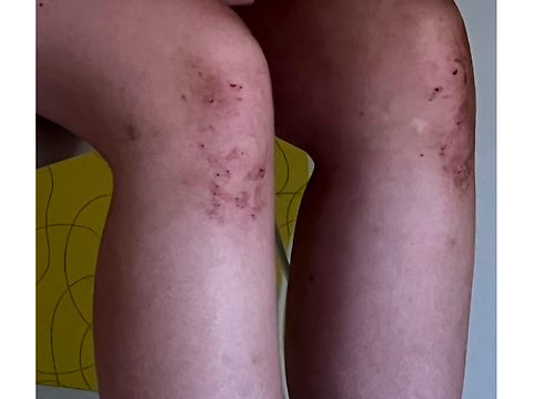 Coexistence of idiopathic nephrotic syndrome, celiac disease, and dermatitis herpetiformis: a rare paediatric case report