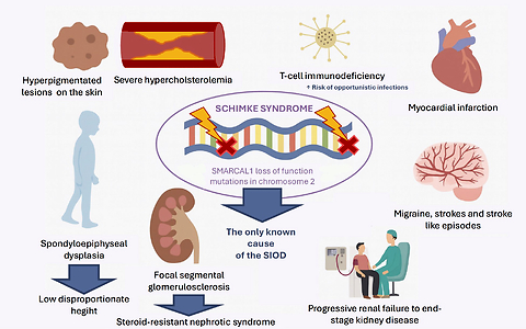 When rarity meets complexity - Schimke immuno-osseous dysplasia with nephrotic syndrome: a 15-year longitudinal case report
