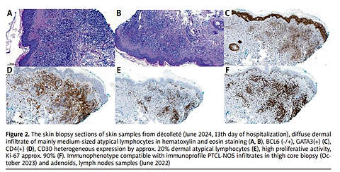 Drug reaction with eosinophilia and systemic symptoms or peripheral T-cell lymphoma? That is the question