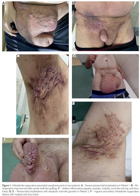 Saxophone Penis as a Rare Consequence of Hidradenitis Suppurativa-associated Penoscrotal Elephantiasis: Two Case Reports and Literature Review