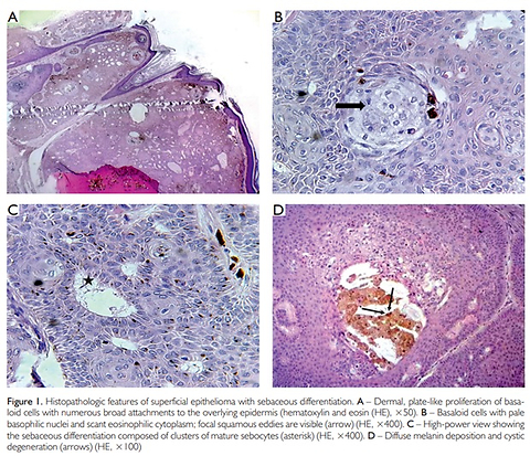 Superficial Epithelioma with Sebaceous Differentiation: a Rare Diagnostic Challenge
