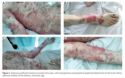 Rituximab in Severe Mucocutaneous Pemphigus Vulgaris Complicated by Sepsis: a Difficult Path to Disease Control