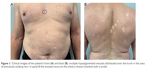 Halo Nevi Phenomenon Revealing Melanoma