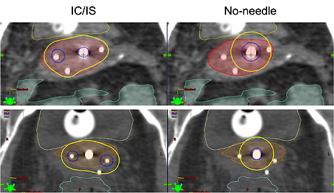 Volume not the defining metric: Dosimetric benefits of adding supplemental interstitial needles for small volume cervical tumors