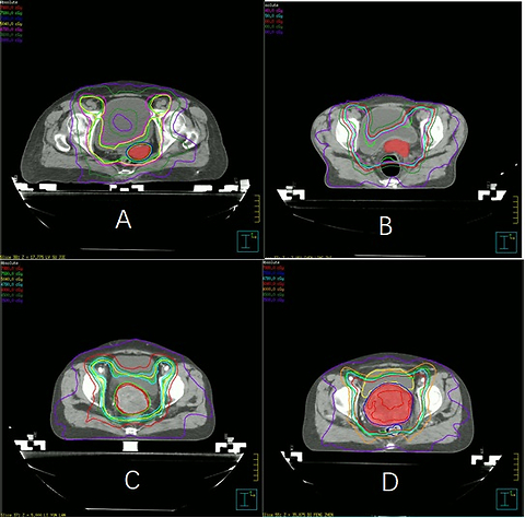 Can image-guided external beam radiotherapy boost be an alternative when intracavitary brachytherapy is unavailable for locally advanced cervical cancer? A dosimetric analysis and literature review