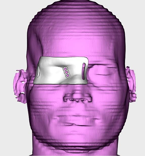 Hybrid adjuvant therapy with 3D-printed orbital brachytherapy and stereotactic body radiotherapy for recurrent adenoid cystic carcinoma: A technical note