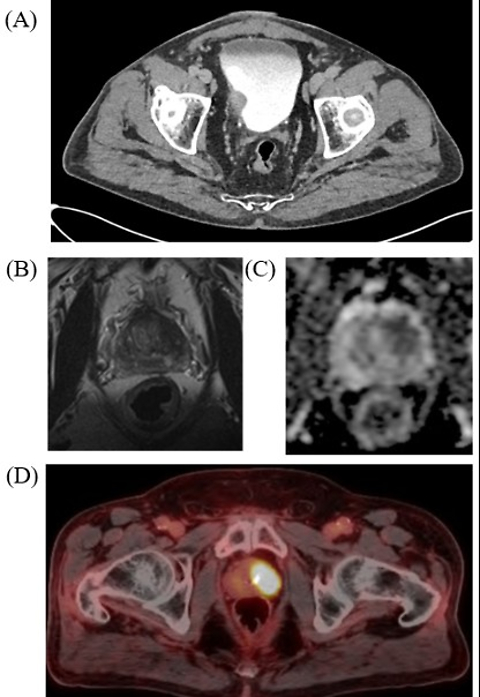 Concurrent chemoradiation and high-dose-rate brachytherapy for synchronous muscle-invasive bladder carcinoma and very high-risk prostate adenocarcinoma: A case report