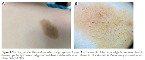 „Bolognia sign” in a congenital melanocytic nevus - a case report