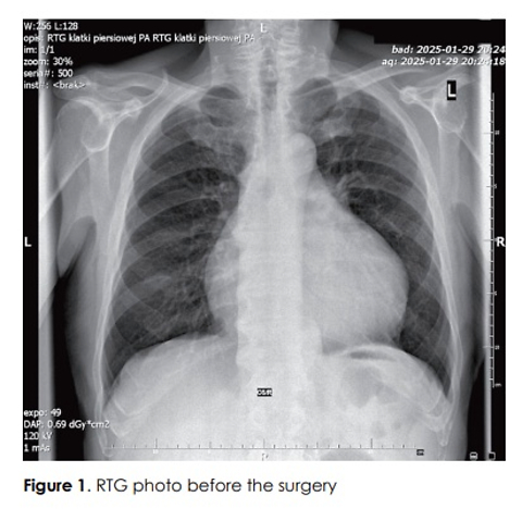 Pericardial fenestration as a palliative treatment for recurrent malignant cardiac tamponade