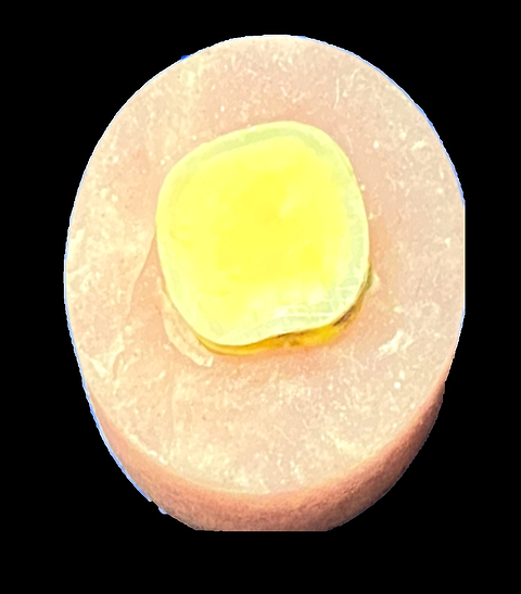 Influence of adhesive strategy and dentin condition on shear bond strength: An in vitro study of sound and artificial caries-affected dentin