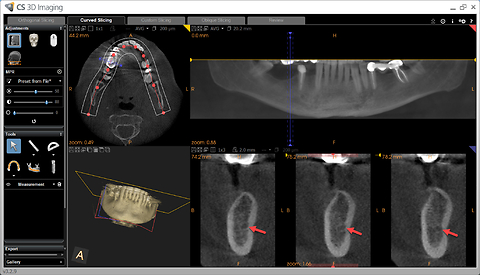 Effect of imaging software on the visibility of mandibular canal at molar implant sites: a cone beam CT study