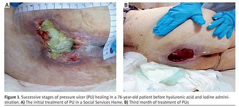 The use of hyaluronic acid in the treatment of pressure ulcers: single-case study